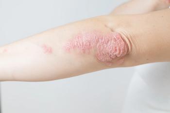 Psoriasis 