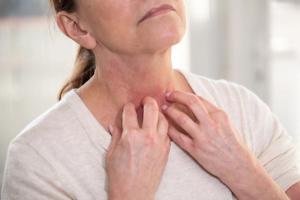 GX-03 Cuts Itch-Related Cytokine IL-31 by Nearly 68% in AD Model