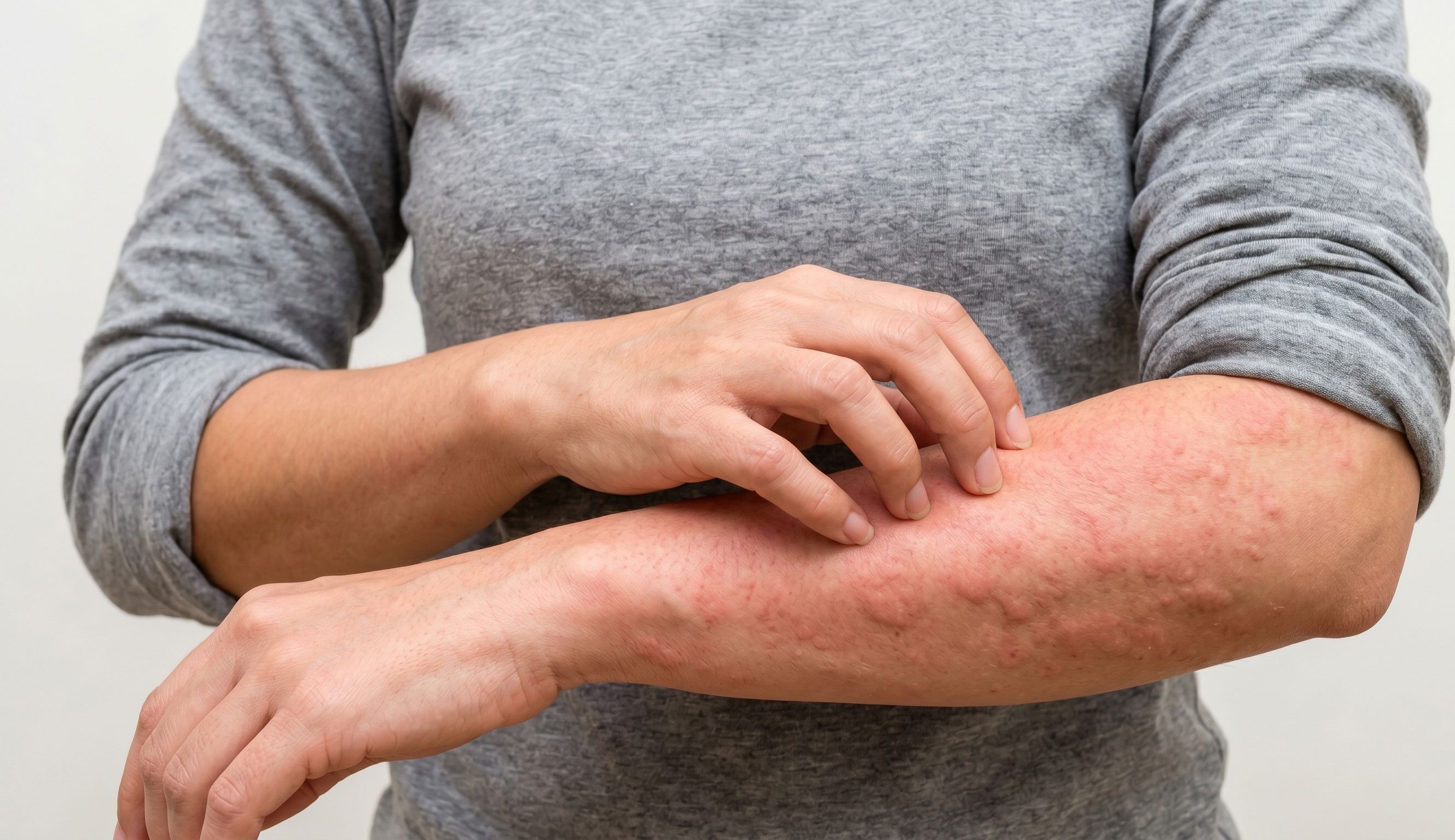 Symptomatic Dermographism in Practice: What APPs Should Know About a New Treatment Option