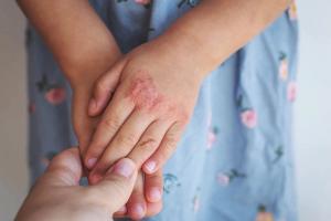 Elevate-Derm Faculty Highlight Expanding Role of Oral JAK Inhibitors in Pediatric Dermatology