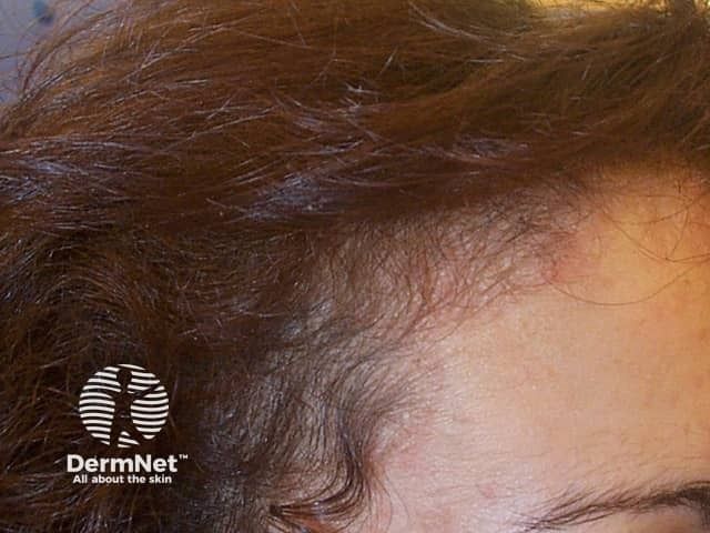 <![CDATA[JAK3 Inhibitor Ritlecitinib Links Molecular Change to Visible Regrowth]]>