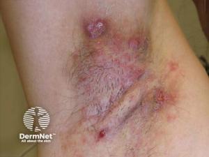Three-Year Data Reinforce Long-Term Efficacy and Safety of Bimekizumab in Hidradenitis Suppurativa