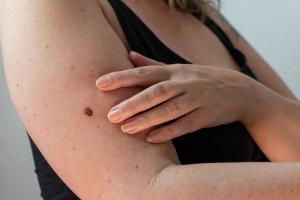 Q&A: What Tudriqev's Approval Means for PD-1-Refractory Melanoma