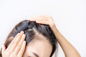 Phase 2 Trial Supports Oral VDPHL01 for Female Pattern Hair Loss