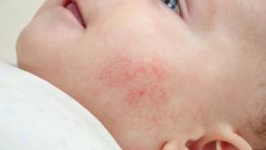 Potential Steroid-Free Option Could Expand Atopic Dermatitis Treatment in Infants
