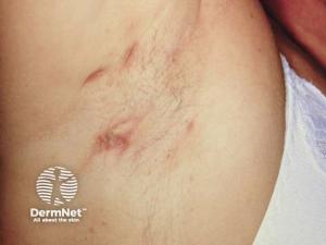 Probiotics in Hidradenitis Suppurativa: Biologic Rationale vs. Clinical Evidence