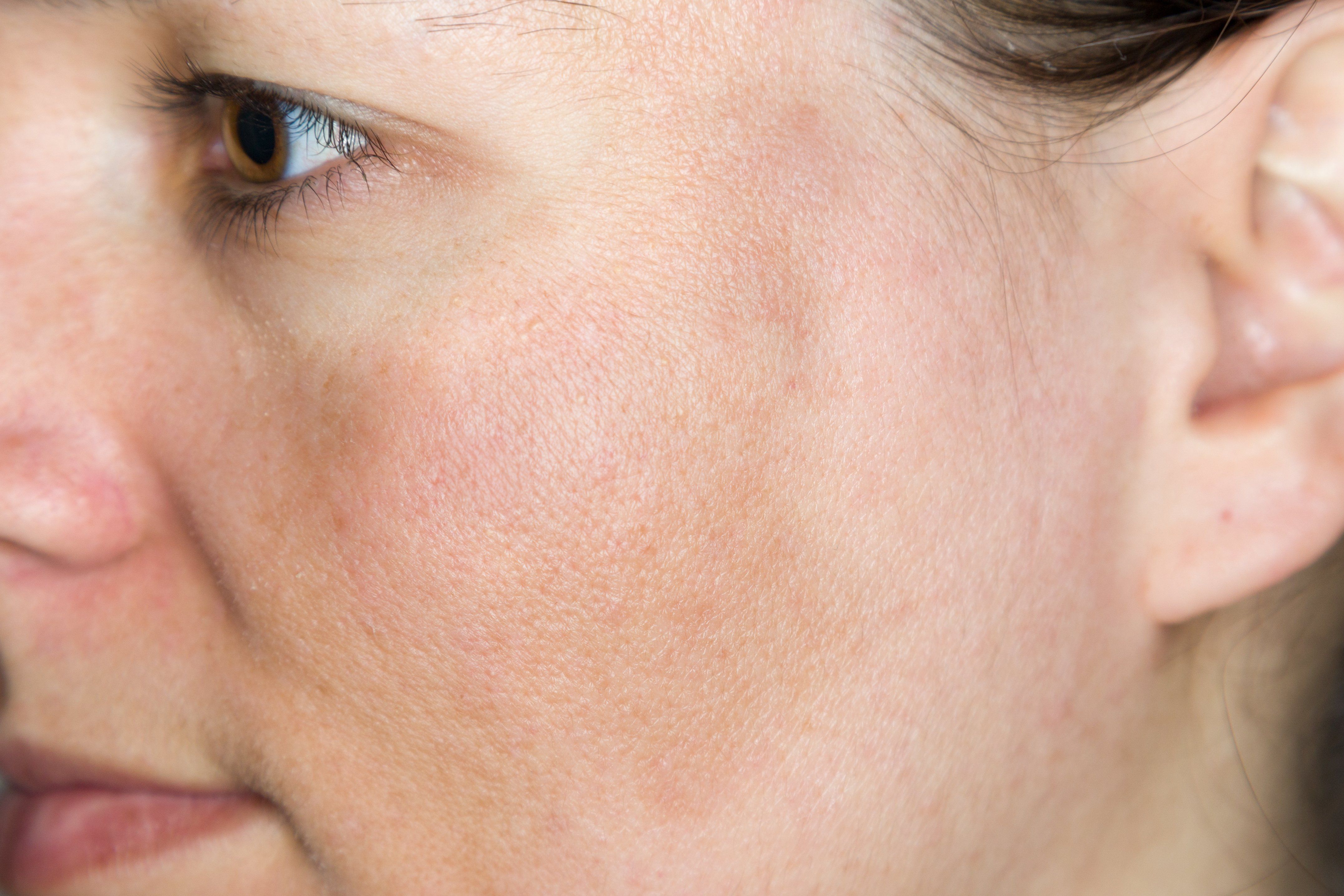 hyperpigmented skin on cheek