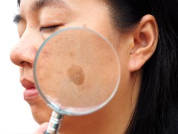 melasma treatments