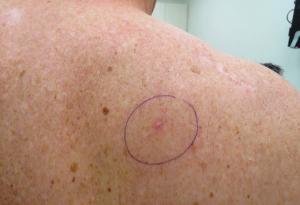 basal cell carcinoma