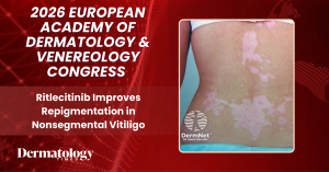 Ritlecitinib Improves Repigmentation in Nonsegmental Vitiligo