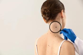 Skin cancer detection