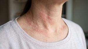 Eczema Awareness Month: Moving Beyond One-Size-Fits-All Care