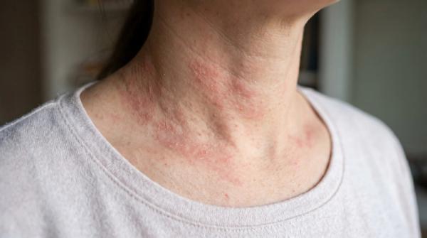 Eczema Awareness Month: Moving Beyond One-Size-Fits-All Care
