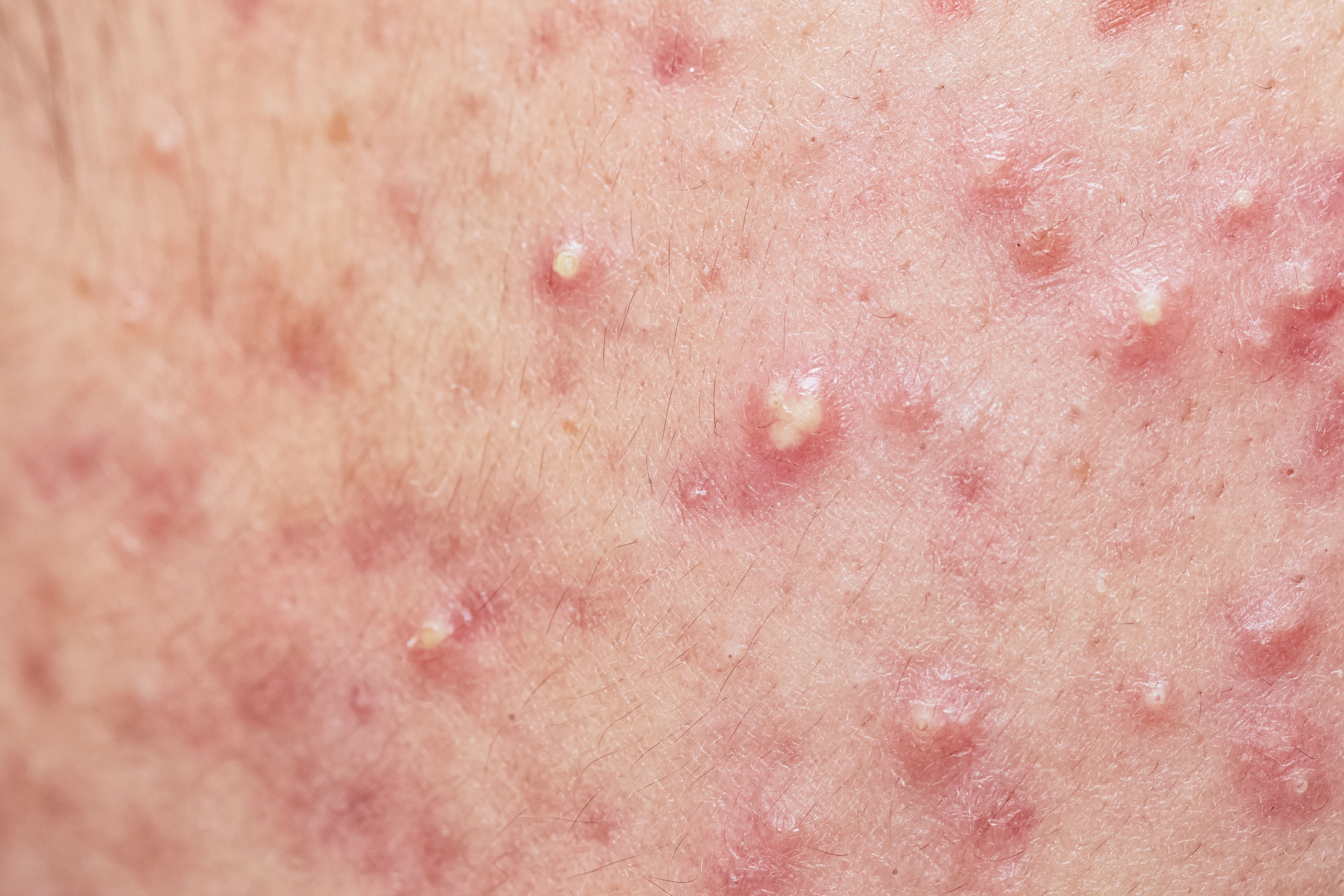 Patient with acne | Image Credit: © praisaeng - stock.adobe.com