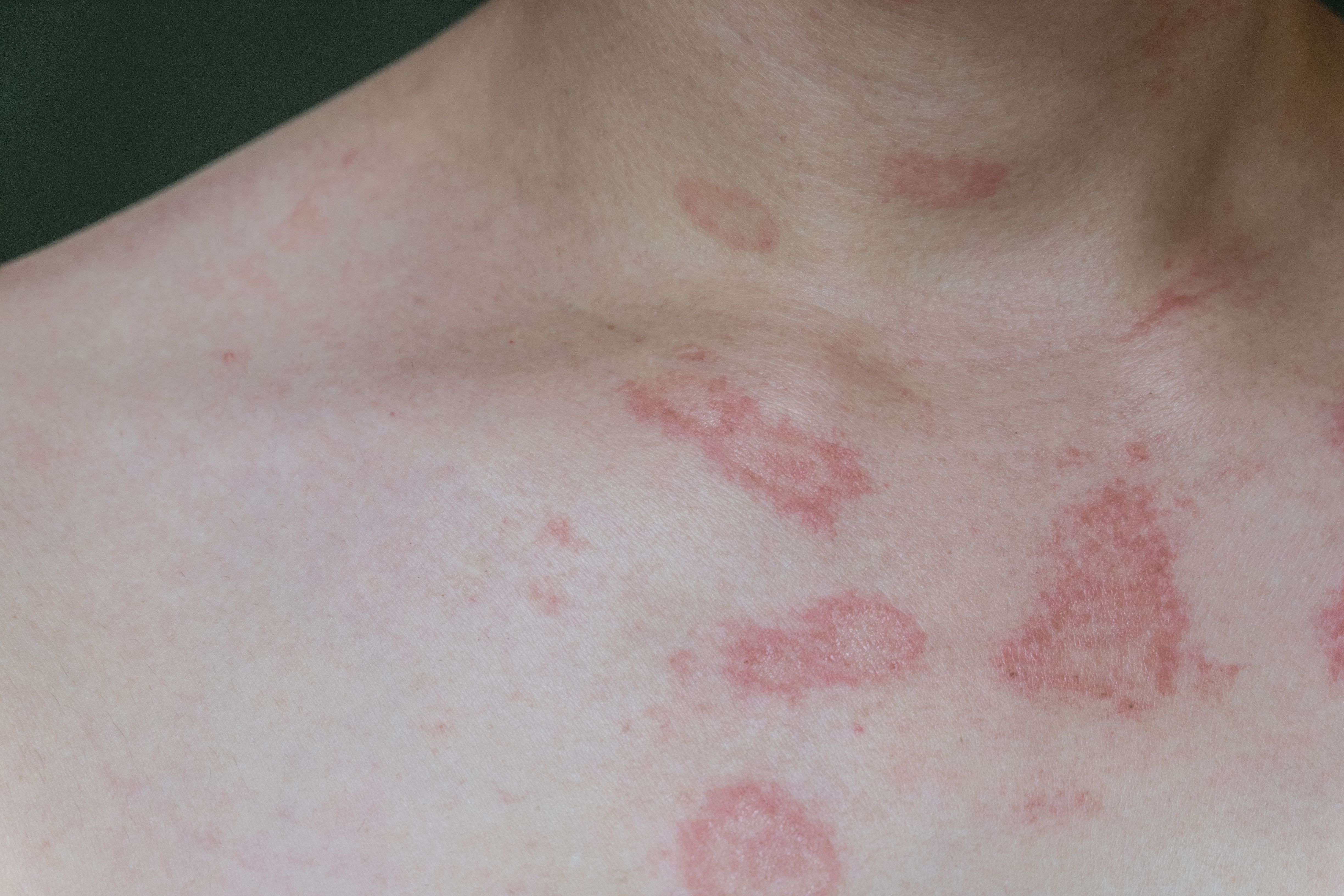 Precision Medicine Offers Hope for More Targeted Rash Diagnosis and ...
