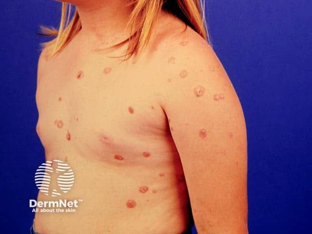 Are Schools Failing Children with Chronic Health Conditions?