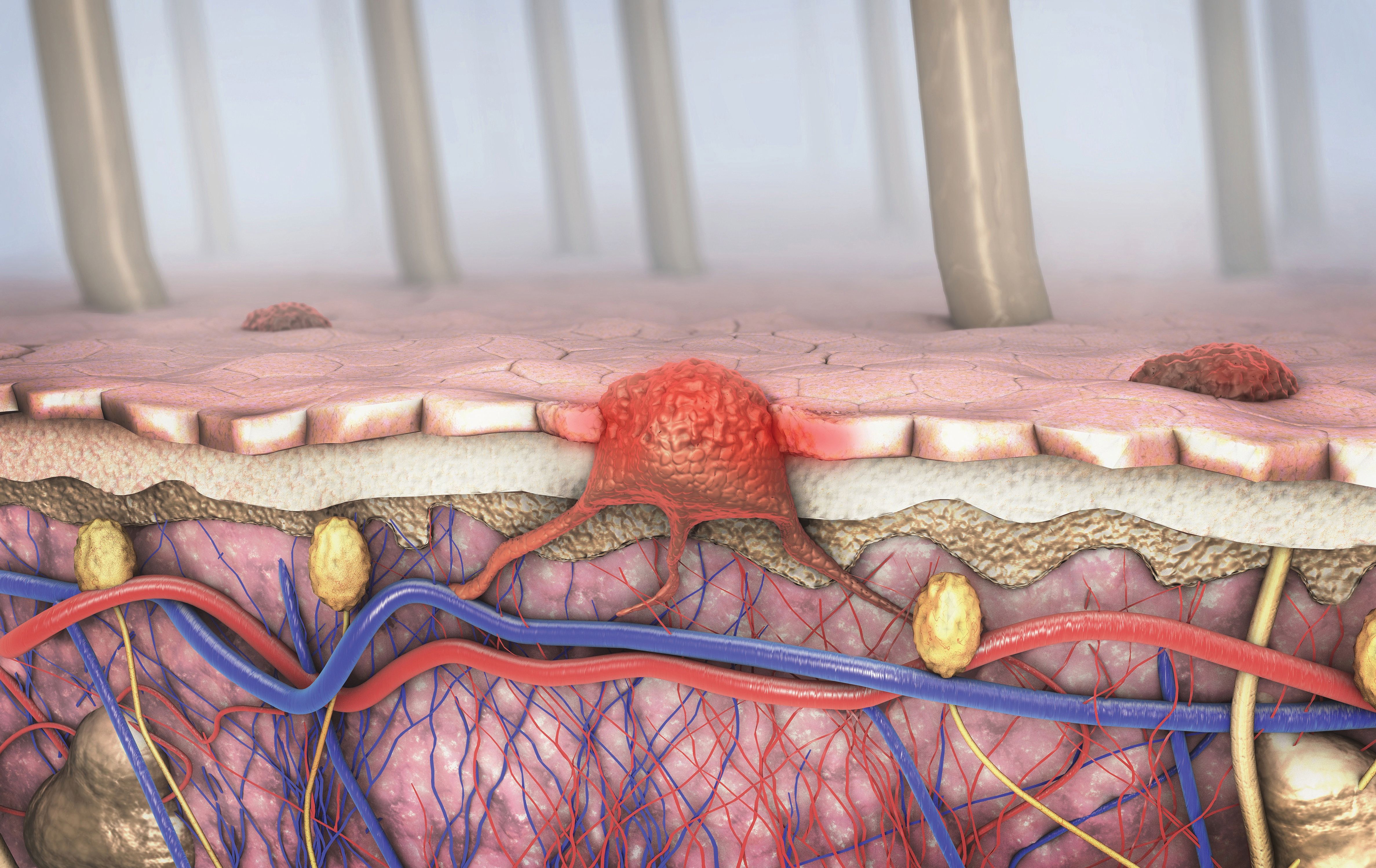 What S New In Melanoma Treatment Dermatology Times And Multimedia