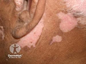 Ritlecitinib Meets Co-Primary End Points in Phase 3 Nonsegmental Vitiligo Trials