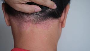 Oral TYK2 Inhibitor Socrodeucitinib Meets Primary Endpoint in Phase 2 Psoriasis Trial