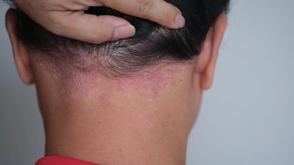 Oral TYK2 Inhibitor Socrodeucitinib Meets Primary Endpoint in Phase 2 Psoriasis Trial