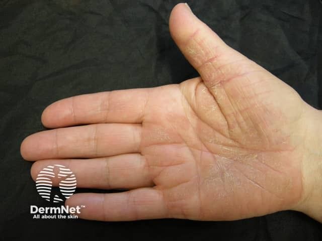 Low BSA Psoriasis Can Carry High Disease Burden