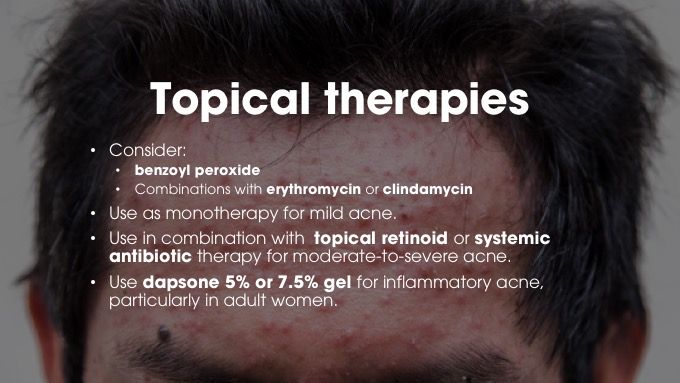 Topical therapies for acne