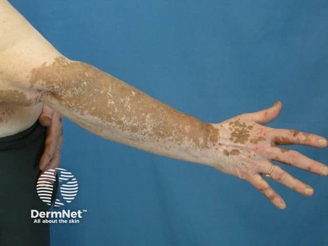 Cross-Cultural Drivers of Psychosocial Burden in Vitiligo
