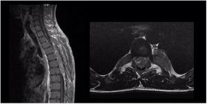 Image IQ: 25-year-old, Progressive Lower Extremity Weakness