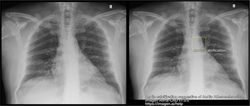 New AI Modality Gets FDA Nod for Detecting Aortic Atherosclerosis and Ectasia on Chest X-Rays