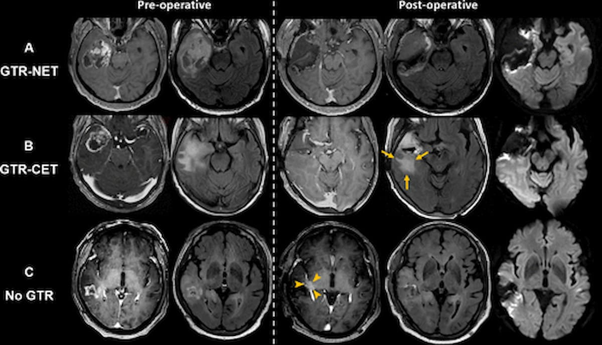 mri glutathione level tumor A,B) Radiation treatment contours for a patient with brain cancer MRI Study Shows Impact of