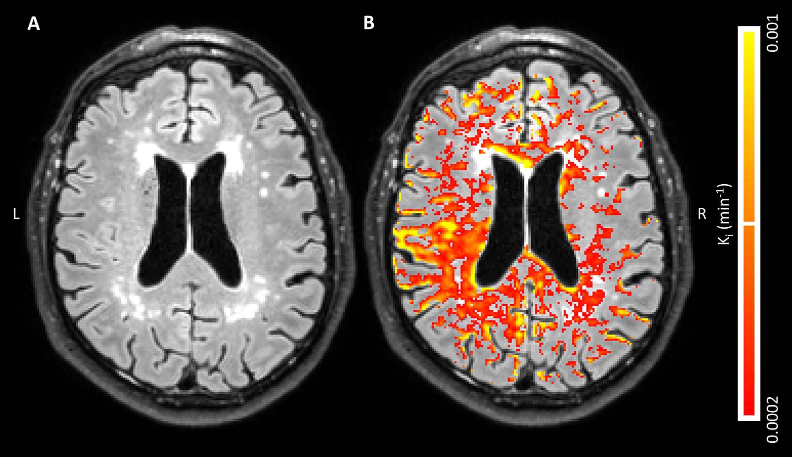 mri-detects-blood-brain-barrier-leaks-in-early-alzheimer-s