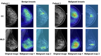 Emerging AI Mammography Model May Enhance Clarity for Initial BI-RADS 3 and 4 Classifications