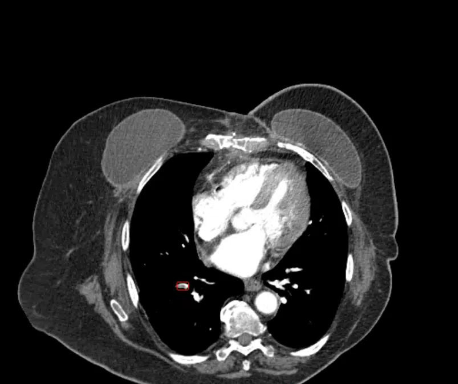 Can a New AI Tool Improve Detection of Incidental Pulmonary Embolism on CT?