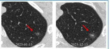 Can CT-Based Deep Learning Bolster Prognostic Assessments of Ground-Glass Nodules?