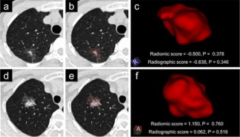 Can Radiomics Bolster Low-Dose CT Prognostic Assessment for High-Risk Lung Adenocarcinoma?