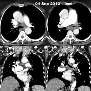Endobronchial Tuberculosis