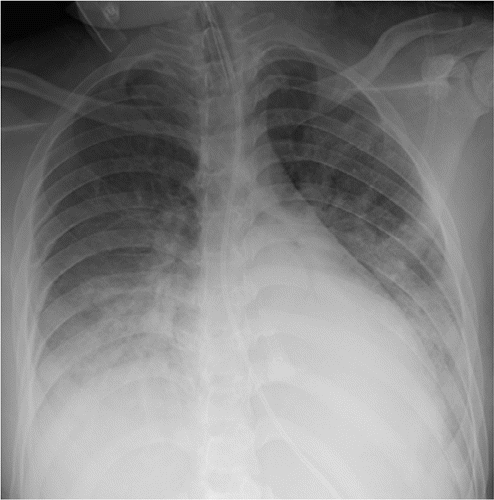 Covid 19 Pneumonia Radiology Case Radiopaedia Org
