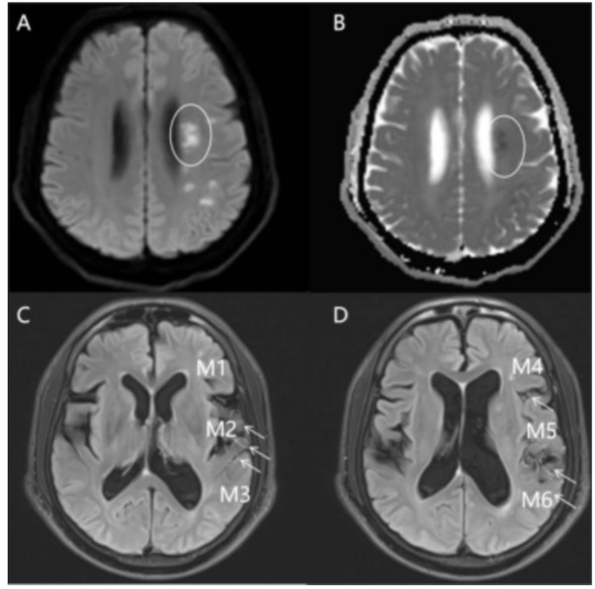 MRI Research Reveals Strong Link Between Vascular Hyperintensity and Cerebral Edema in Patients with Acute Ischemic Stroke