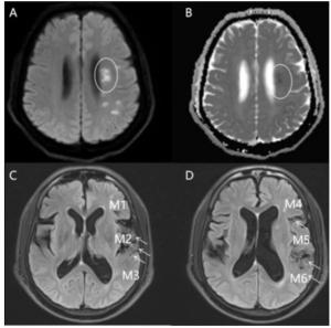 MRI Research Reveals Strong Link Between Vascular Hyperintensity and Cerebral Edema in Patients with Acute Ischemic Stroke