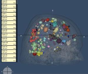 FDA Clears MRI-Based AI Software for Assessment of Brain Metastases