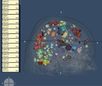 FDA Clears MRI-Based AI Software for Assessment of Brain Metastases