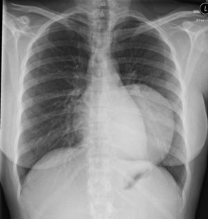 Asymptomatic Thoracic Schwannoma