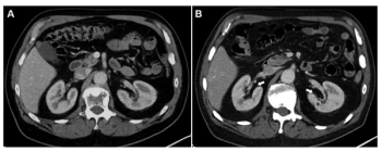 Can CT-Based AI Help Predict Renal Function Decline After Radioligand Therapy for mCRPC?