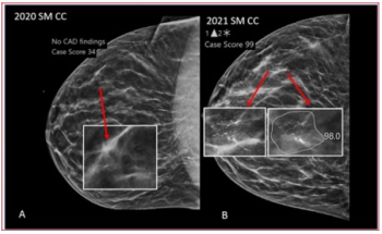 Can AI Bolster Breast Cancer Detection in DBT Screening?