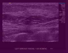 FDA Clears AI-Powered Breast Ultrasound Software from DeepHealth