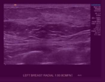 FDA Clears AI-Powered Breast Ultrasound Software from DeepHealth