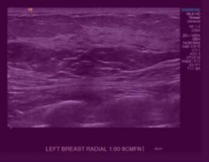 FDA Clears AI-Powered Breast Ultrasound Software from DeepHealth