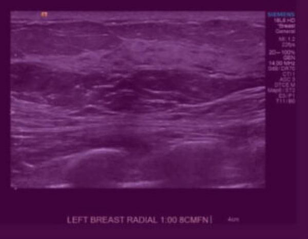 FDA Clears AI-Powered Breast Ultrasound Software from DeepHealth