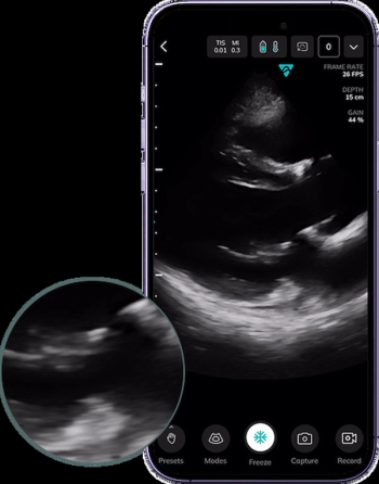 Vave Health Unveils Handheld, Whole-Body Ultrasound Device