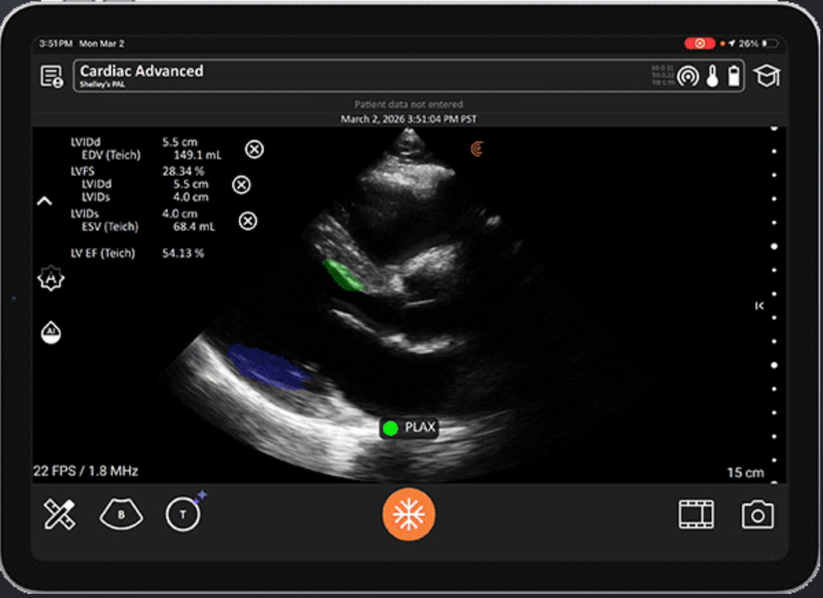 FDA Clears AI Ultrasound Software for Automated LVEF Calculation